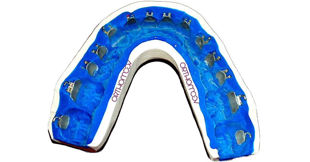 Collage indirect vestibulaire transfert