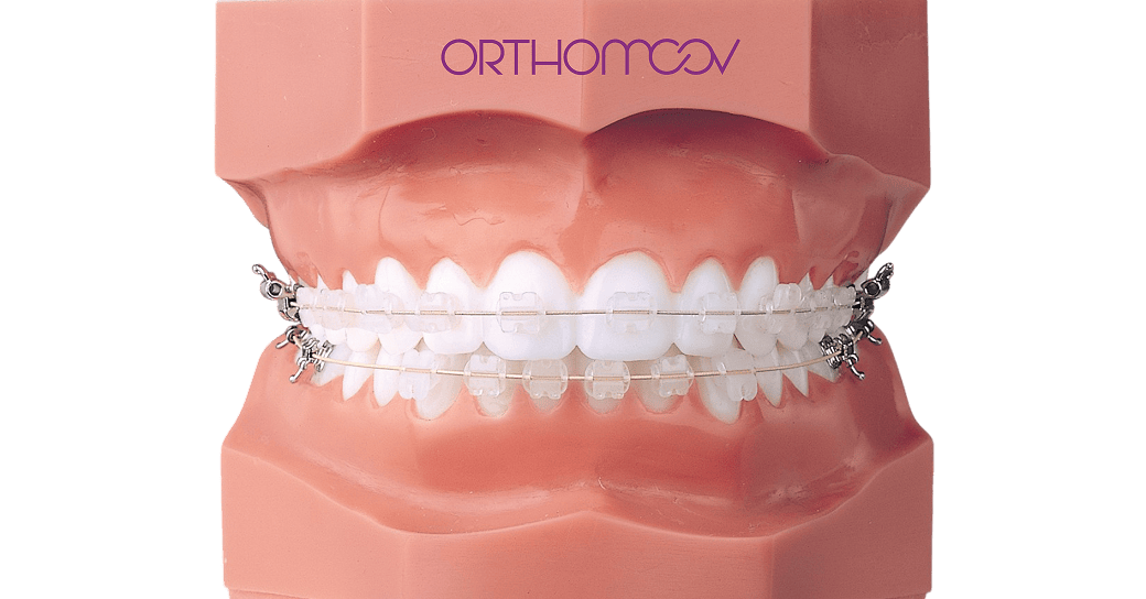 Collage indirect vestibulaire